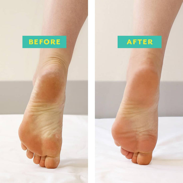 Before and after comparison of a heel showing smoother, softer skin after using PoshPeel™ Pedi Cure | Patchology for effective skincare and body care treatment.