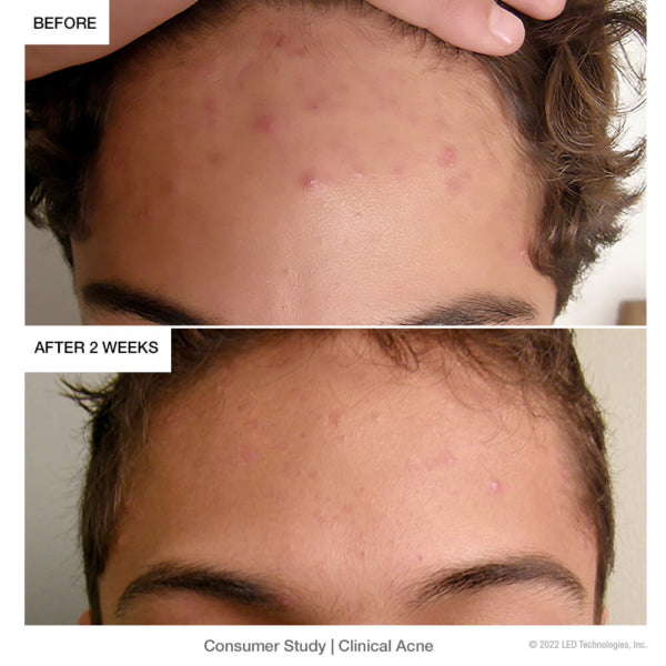 OPEN BOX Clinical Acne : Blue Light Therapy for Acne