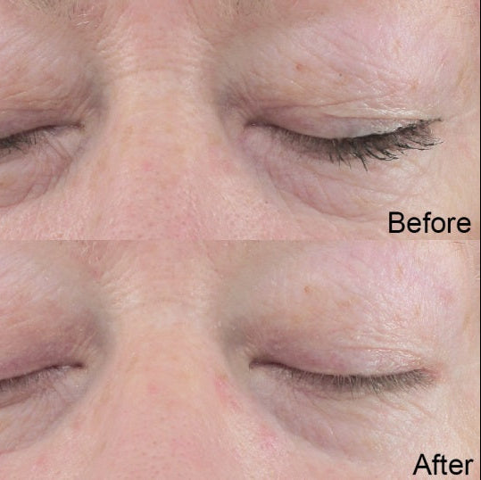 Two before and after images of white skin eye area using best skin plumping serum. Dermal Essentials Clinical Skincare.